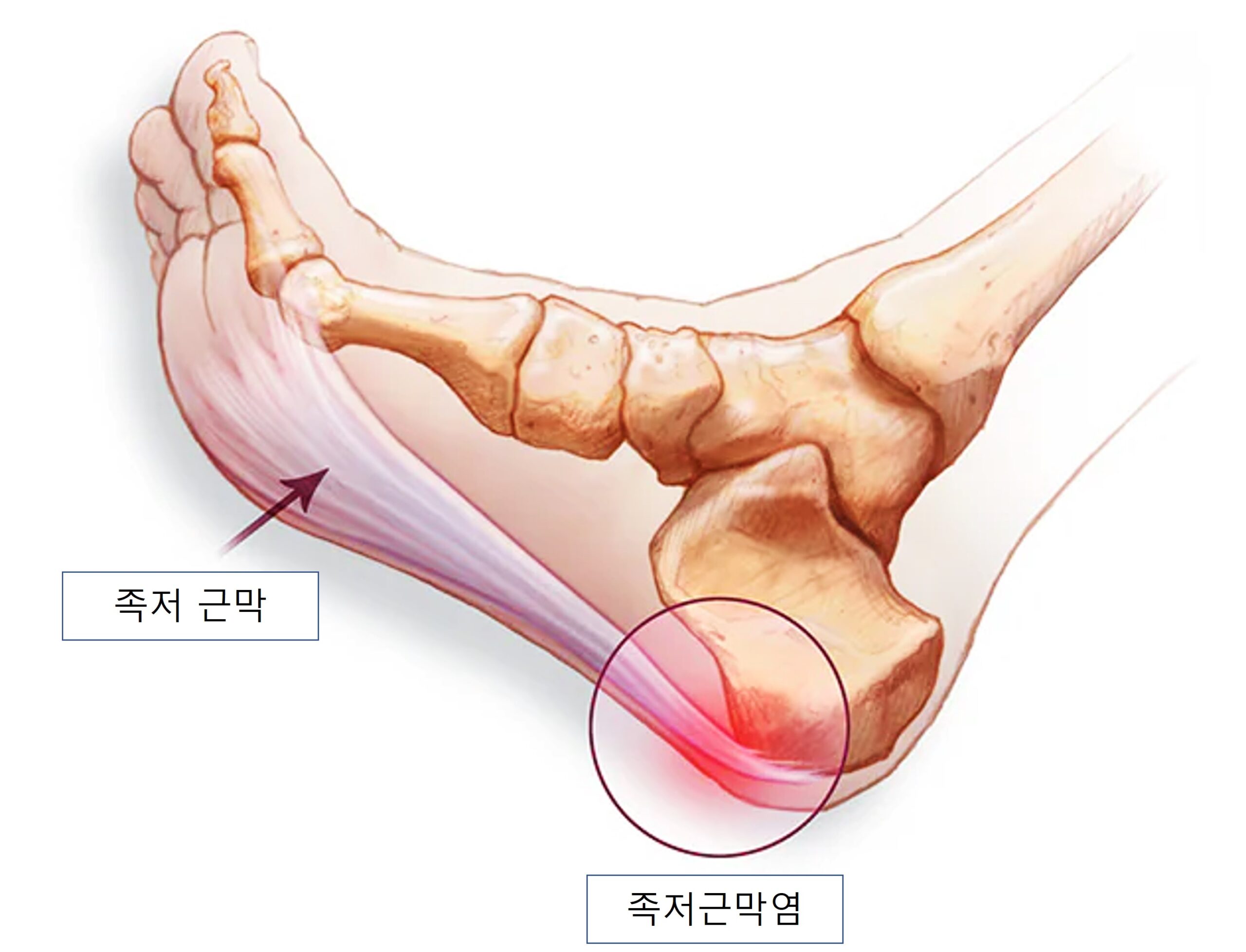 족저근막염
